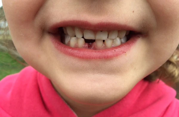 A child's mouth, smiling with a bottom tooth missing